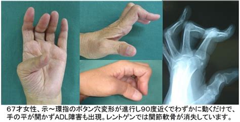 指穴|ボタン穴変形の治療と手術｜大阪の南川整形外